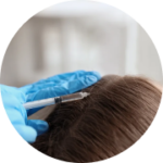 Mesoterapia Capilar