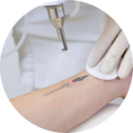 Remoção de Tatuagens